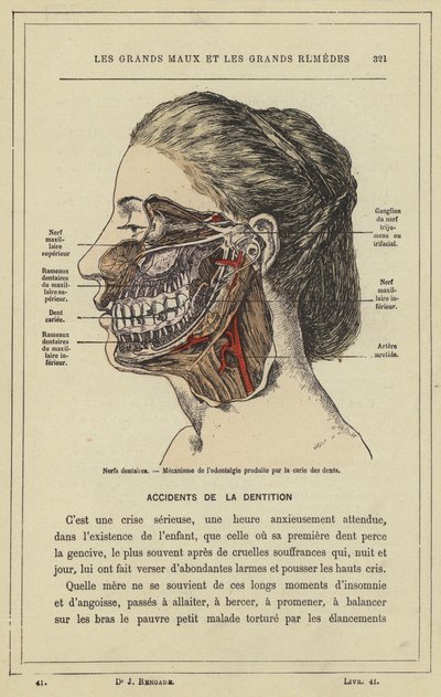 Nerwy zębowe, Mechanizm odontalgii wywołanej próchnicą (kolor lito) autorstwa French School