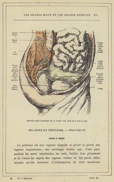 Ostre zapalenie otrzewnej spowodowane pęknięciem ropnia dołu biodrowego (kolor lito) autorstwa French School