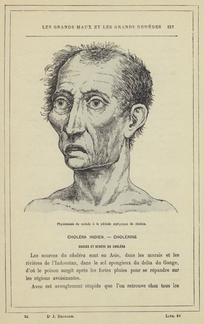 Fizjonomia chorego w okresie asfiksji cholery (kolor lito) autorstwa French School