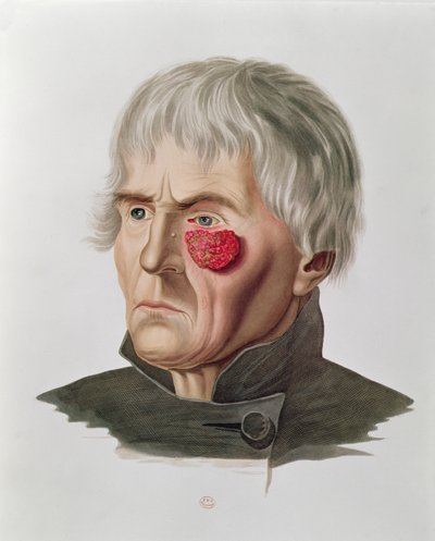 Choroba skóry przed operacją, z Selecta Praxis Medico-Chirurgica by Alexander Auvert, Paryż, 1856 autorstwa French School