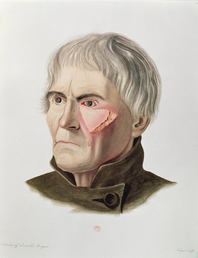Operacja przeszczepu skóry, z Selecta Praxis Medico-Chirurgica, Alexander Auvert, Paryż, 1856 autorstwa French School