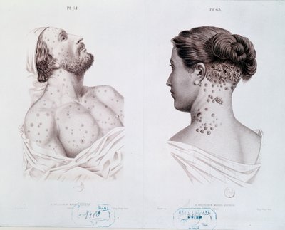 Objawy kiły u mężczyzn i kobiet, z książki medycznej, ok. 1850-60 autorstwa French School