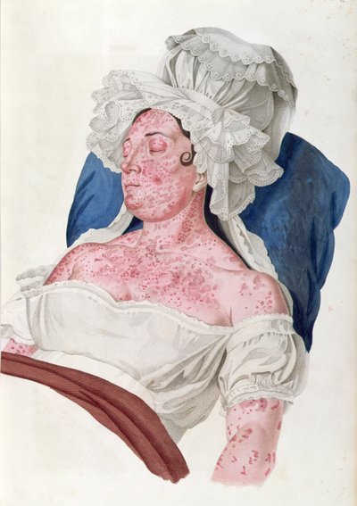 Kobieta ze szkarlatyną, z książki barona Jean Louis Alibert (1768-1837) rytowanej przez Chouparda, 1833 autorstwa French School