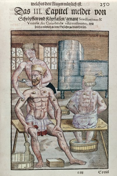Cupping z Ophthalmodouleia Georga Bartischa (1535-1636) wydany w Dreźnie w 1583 r. (kolorowy drzeworyt) autorstwa German School