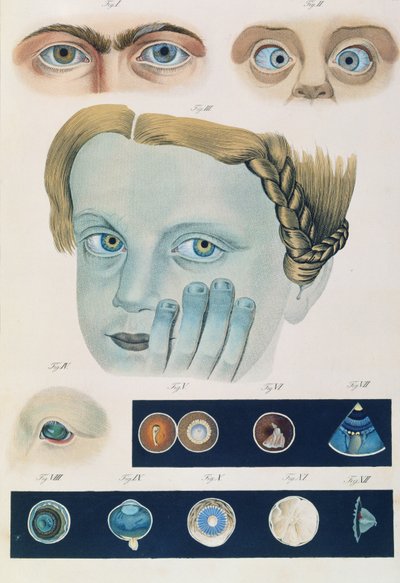 Opis wrodzonych anomalii oka, z Obrazów klinicznych chorób i wad wzroku ludzkiego oka, Friedrich August von Ammon (1799-1861) 1838 autorstwa German School
