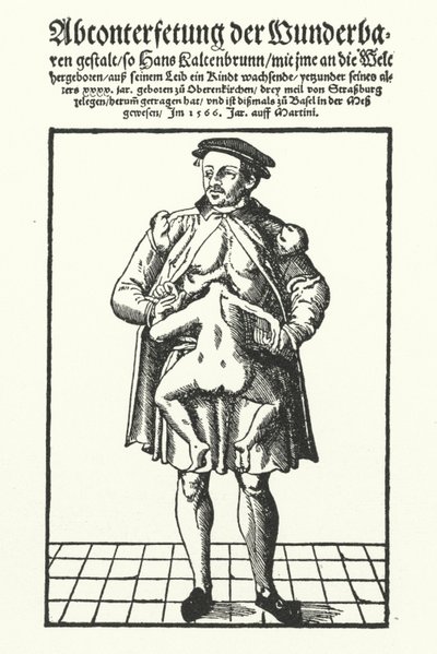 Hans Kaltenbrunn i jego nierozwinięty bliźniak syjamski (rycina) autorstwa German School