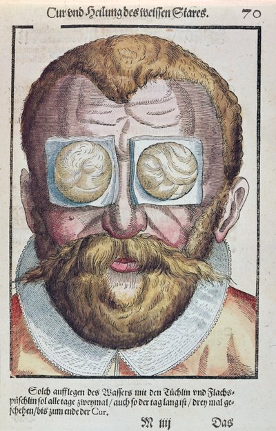 Leczenie choroby oka, z Ophthalmodouleia Georga Bartischa (1535-1636) wydanej w Dreźnie w 1583 r. (kolorowy drzeworyt) autorstwa German School