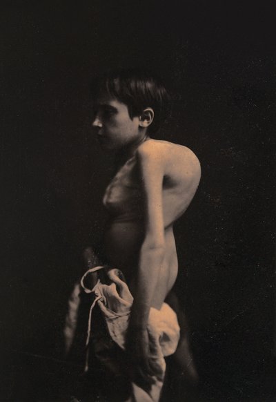 Portret chłopca garbusa, ok. 1855-57 autorstwa Guillaume Benjamin Armand Duchenne de Boulogne