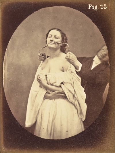 Rys. 78 autorstwa Guillaume Benjamin Duchenne