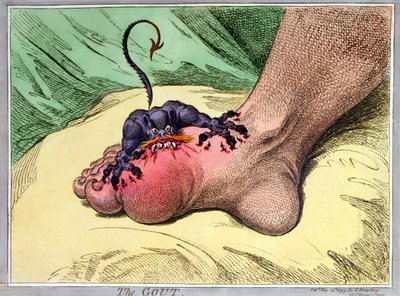 Podagra, opublikowana przez Hannah Humphrey w 1799 (ręcznie barwiona akwaforta na miękkim podłożu) autorstwa James Gillray