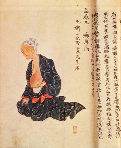 Pierwsze chirurgiczne leczenie raka piersi przeprowadzone w znieczuleniu ogólnym przez Seishu Hanaokę (1760-1836) w 1804 roku autorstwa Japanese School