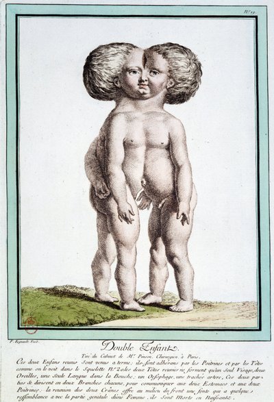 Dzieci syjamskie - w „Odchyleniach natury” autorstwa Régnault autorstwa Jean Baptiste Regnault