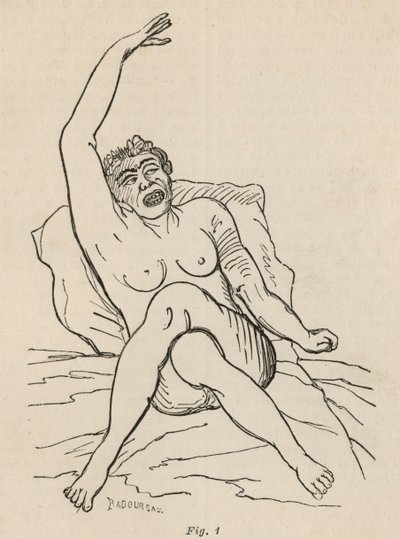 Epilepsja histeryczna, atak, skurcze, rys. 1 z "Iconographie Photographique de La Salpetriere" Bourneville et P. Regnard, Paryż, 1876 autorstwa Jean Francois Badoureau