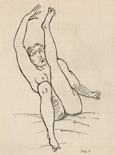 Epilepsja histeryczna, atak, wygięcia, ryc. 2 z „Iconographie Photographique de La Salpetriere” Bourneville et P. Regnard, Paryż, 1876 autorstwa Jean Francois Badoureau