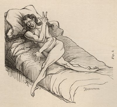 Epilepsja histeryczna, atak, wygięcia, ryc. 3 z „Iconographie Photographique de La Salpetriere” Bourneville et P. Regnard, Paryż, 1876 autorstwa Jean Francois Badoureau