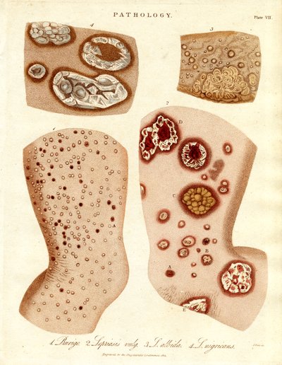 Patologiczne choroby skóry: Schurigie;Leprous Skin;Pallada i Impetigo autorstwa John Pass
