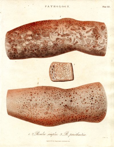 Erupcje skórne - Roseola simplex i Roseola paristhmitica autorstwa John Pass