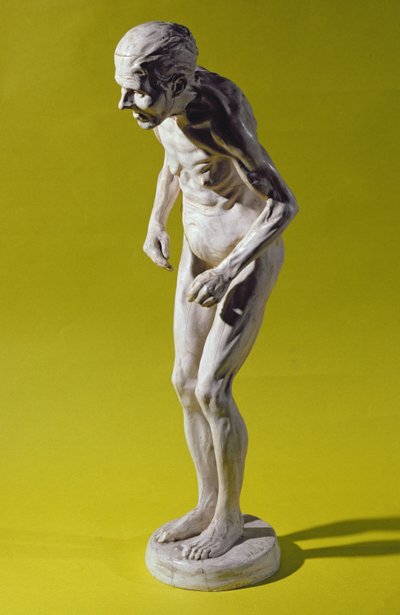 Figura kobiety z chorobą Parkinsona (gips) autorstwa Paul Marie Louis Pierre Richer