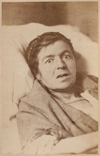 Epilepsja histeryczna, skurcz twarzy, płyta VIII z "Iconographie Photographique de La Salpetriere" Bourneville et P. Regnard, Paryż, 1876 (odbitka albuminowa) autorstwa Paul Regnard