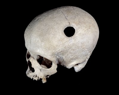Prehistoryczna czaszka ze śladem trepanacji, Muzeum Starożytności Narodowej. autorstwa Prehistoric Prehistoric