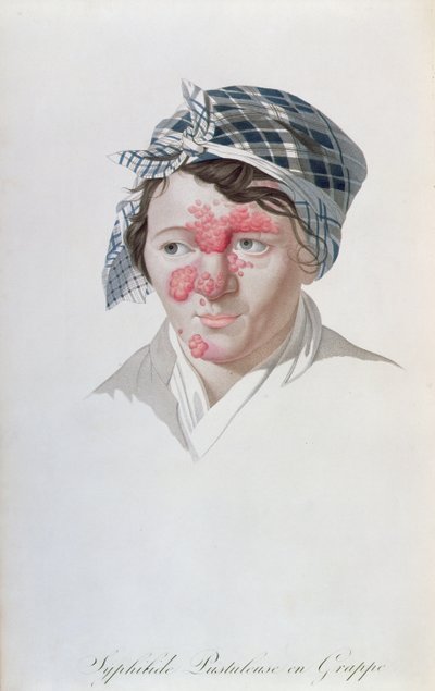 Krosty kiły, z książki barona Jeana Louisa Aliberta (1768-1837) 1838 autorstwa Salvadore Tresca