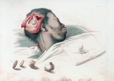 Widok rany w czaszce po trefinacji i usunięciu rozbitego kawałka kości w lewym dolnym rogu, 1821 autorstwa Thomas Landseer