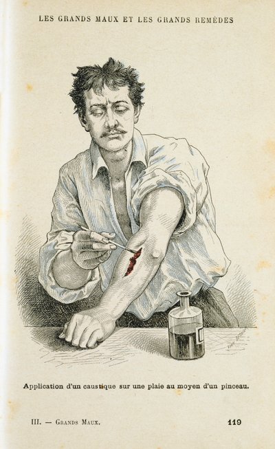 Malowanie rany roztworem antyseptycznym, c1890 autorstwa Unbekannt