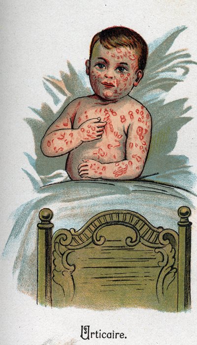 Choroby dzieci: pokrzywka. W „Nowej medycynie naturalnej” F.E. Bilza. autorstwa Unknown artist