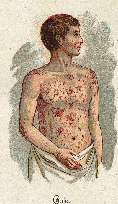 Choroby dziecięce: świerzb. W „Nowym naturalnym leku” F.E. Bilz. autorstwa Unknown artist