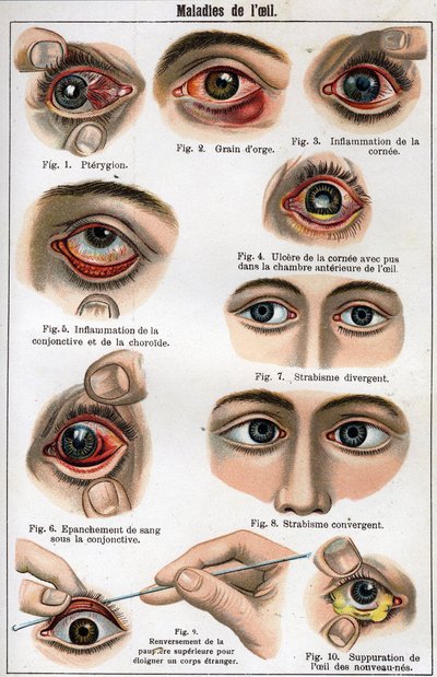 Choroby oka. „Nowa medycyna naturalna” autorstwa F.E. Bilza. autorstwa Unknown artist
