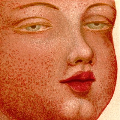 Wybuchowe gorączki: Scarlatina lub Scarlet Fever autorstwa Unknown artist