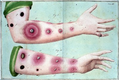Objawy choroby ospy powodującej pojawienie się krost na skórze. Tabliczka medyczna z „Leczenia szczepień” Luigi Sacco, Mediolan autorstwa Unknown artist