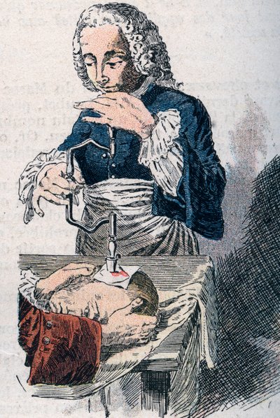 Trepanacja. Druk z XVIII wieku. autorstwa Unknown artist