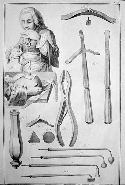 Trepanacja czaszki, różne instrumenty (grawerowanie autorstwa Unknown artist