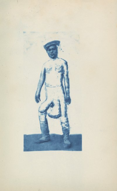 Elephantiasis, c. 1870 (zdjęcie) autorstwa Unknown photographer