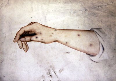 Studium przedramienia ze stanem skóry, ok. 1850 (akwarela na papierze) autorstwa William Lover
