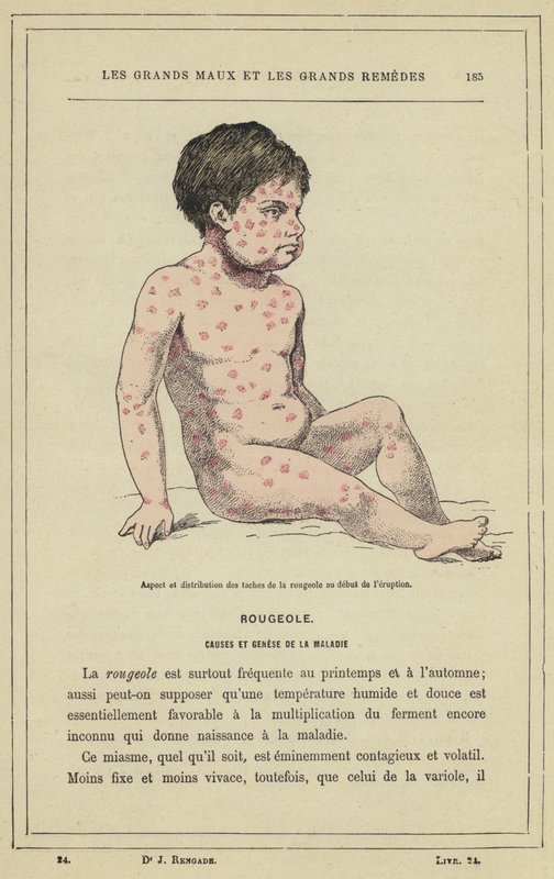 Wygląd i rozmieszczenie plam odry na początku erupcji (litografia kolorowa) autorstwa French School