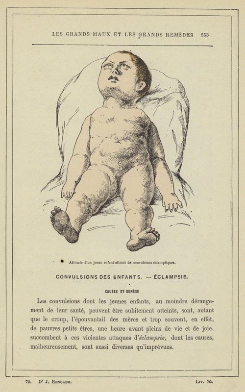 Postawa małego dziecka z drgawkami rzucawkowymi (litografia kolorowa) autorstwa French School