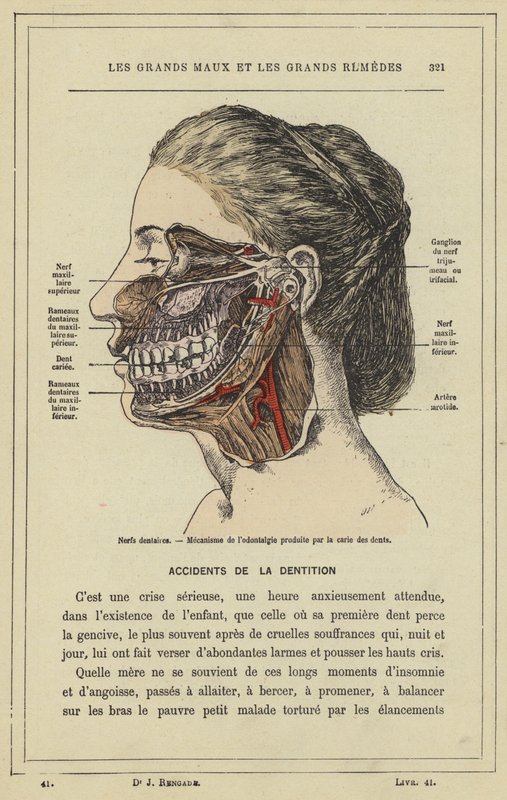 Nerwy zębowe, Mechanizm odontalgii wywołanej próchnicą (kolor lito) autorstwa French School