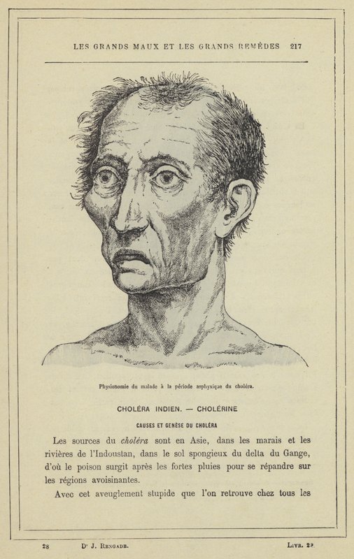 Fizjonomia chorego w okresie asfiksji cholery (kolor lito) autorstwa French School