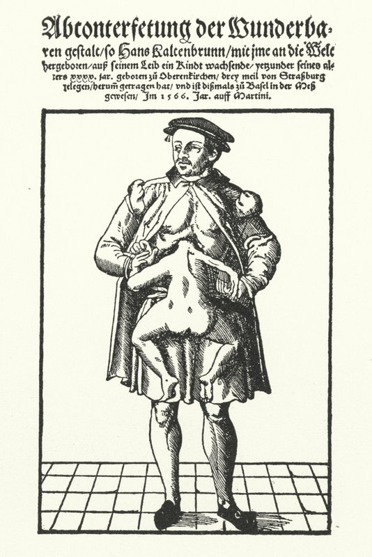 Hans Kaltenbrunn i jego nierozwinięty bliźniak syjamski (rycina) autorstwa German School