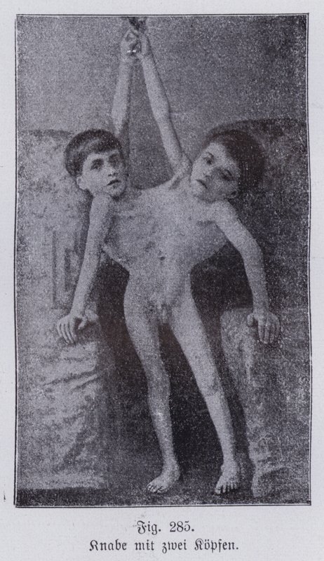 Giacomo i Giovanni Battista Tocci, włoskie bliźnięta syjamskie (zdjęcie czarno-białe) autorstwa Italian Photographer