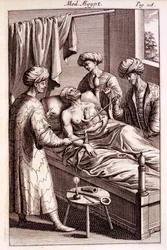 Ilustracja moxibustion z Medicina Aegyptorum autorstwa Prospero Alpinusa, 1745