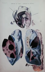 Apopleksja serca i płuc, płyta ilustracyjna z „Anatomie pathologique du corps humain” Jeana Cruveilhiera (1791-1874), wydanej w Paryżu