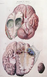 Nowotwory nowotworowe mózgu, z „Anatomie Pathologique du Corps Humain” Jeana Cruveilhiera (1791-1874) 1828-42 (kolorowe grawerowanie)