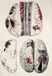 Udar kapilarny, z „Anatomie Pathologique du Corps Humain” Jeana Cruveilhiera (1791-1874) 1828-42 (kolorowa grawerunek)