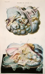 Choroby jajników, z „Anatomie Pathologique du Corps Humain” Jeana Cruveilhiera (1791-1874) 1828-42 (kolorowa grawerunek)