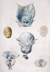 Choroby pęcherza moczowego i prostaty, z „Anatomie Pathologique du Corps Humain” Jeana Cruveilhiera (1791-1874) 1828-42 (kolorowa rycina)