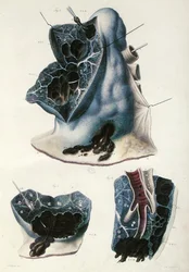 Choroby płuc, z „Anatomie Pathologique du Corps Humain” Jeana Cruveilhiera (1791-1874) 1828-42 (kolorowa grawerunek)