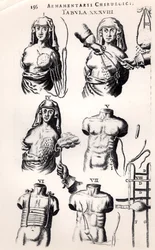 Operacja raka piersi, z Armamentarii Chirurgici Johannesa Schultesa (1595-1645), opublikowanego w Amsterdamie w 1672 roku